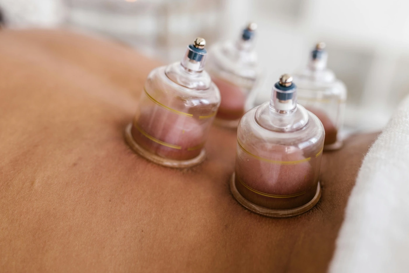 Cupping therapy and electro-acupuncture in Cape Town