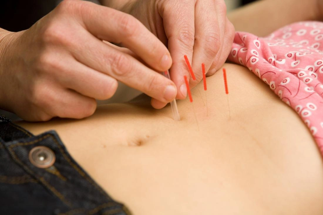 Fertility acupuncture and IVF support in Cape Town