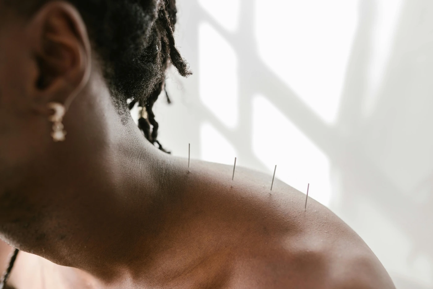 Acupuncture for neck and shoulder pain in Cape Town